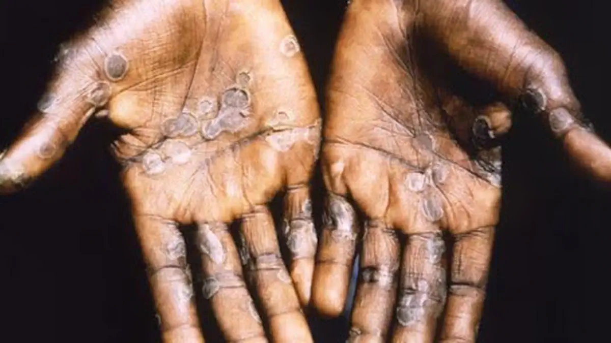 Health Alert: Mpox Cases Climb in Greater Accra