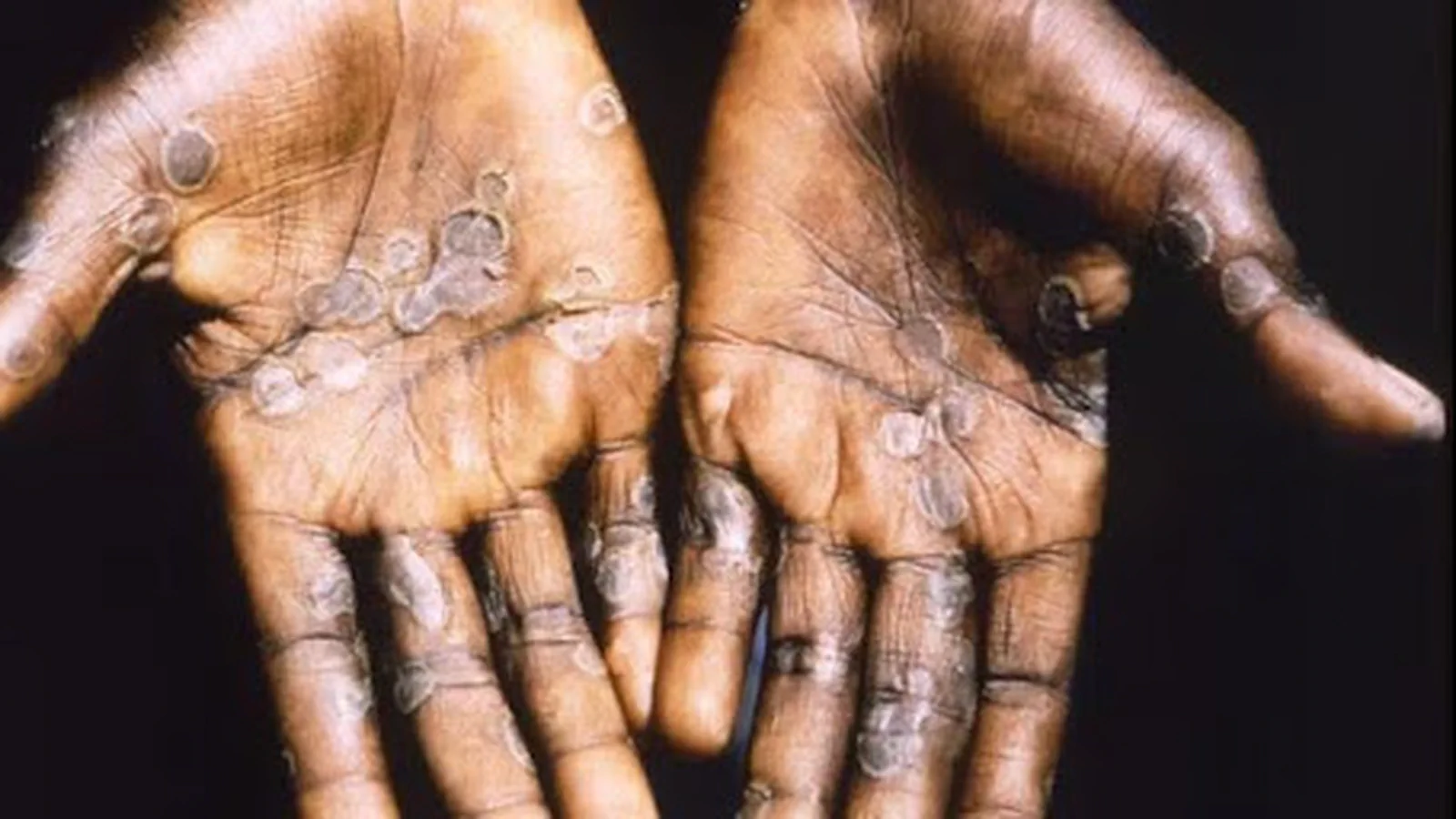 Health Alert: Mpox Cases Climb in Greater Accra