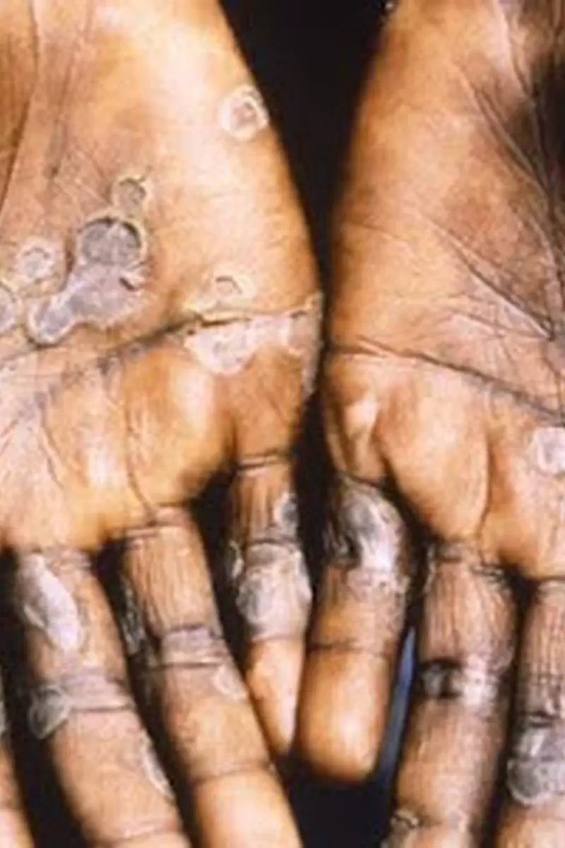 Health Alert: Mpox Cases Climb in Greater Accra